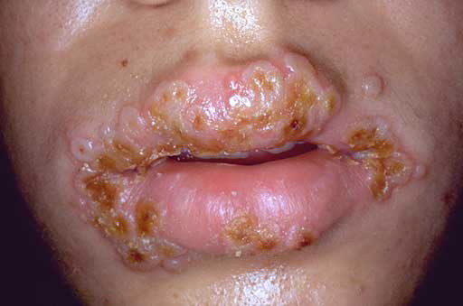 klamydia sår klamydia sår